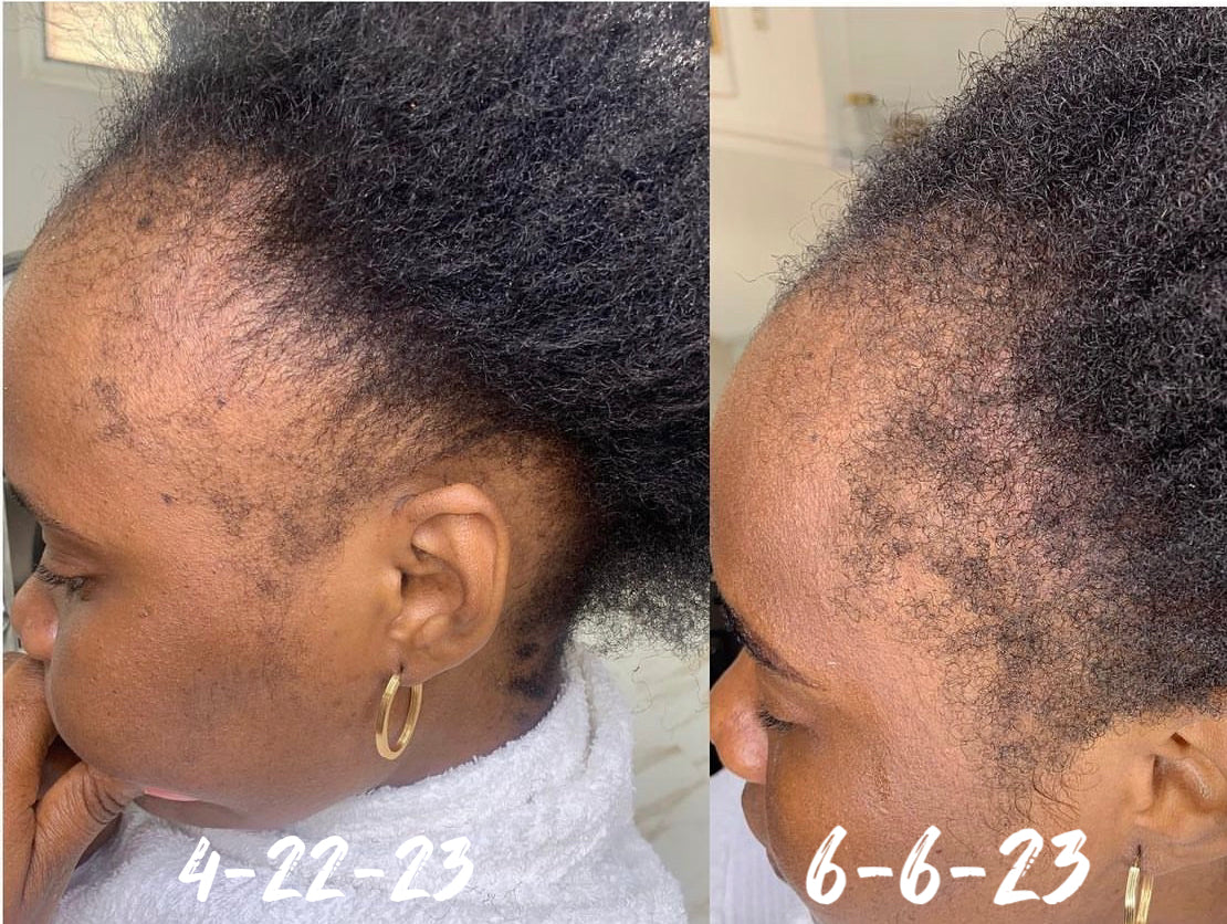 Hairline & Temple Recovery Oil